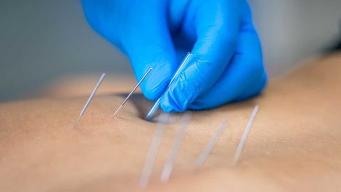 Acupuntura