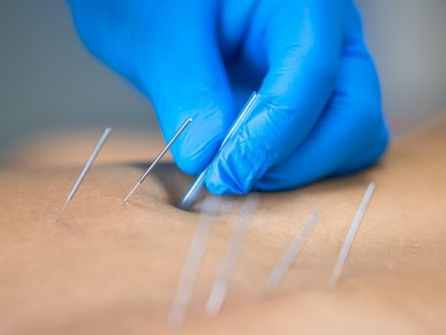 Acupuntura